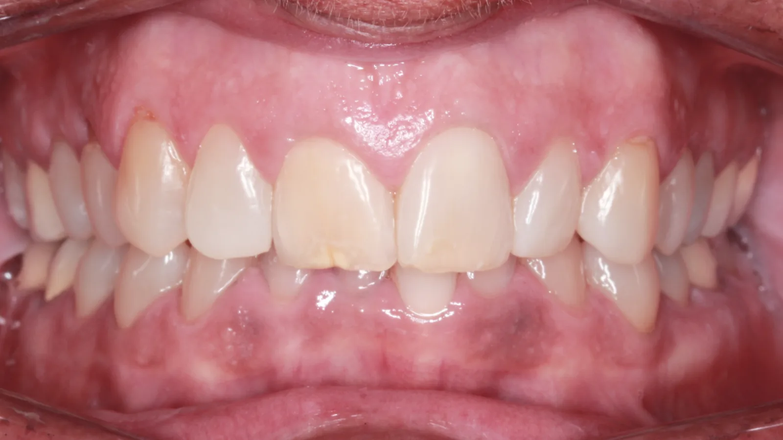 Before teeth alignment comparison: Intraoral before photo of Removable Clear Aligners showing the patient sought a discreet, minimally invasive treatment option and was treated with removable clear aligners.