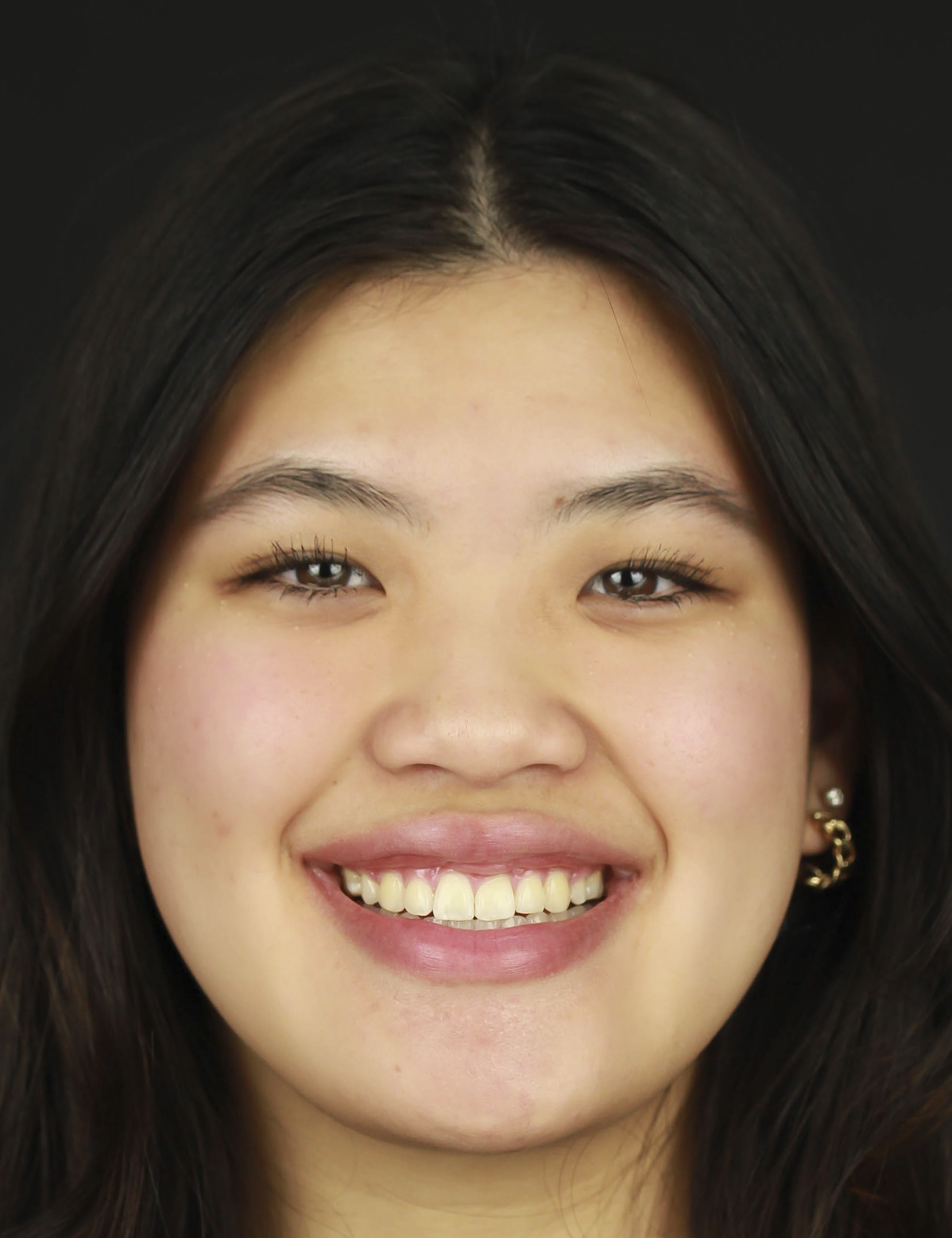 After Metal Self-Ligating Braces & Orthognathic Surgery treatment