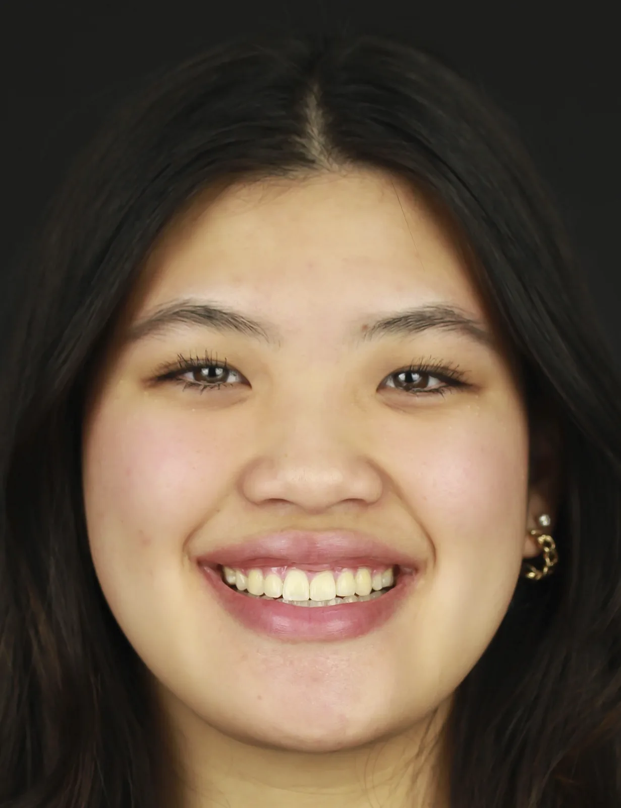 After Metal Self-Ligating Braces & Orthognathic Surgery treatment