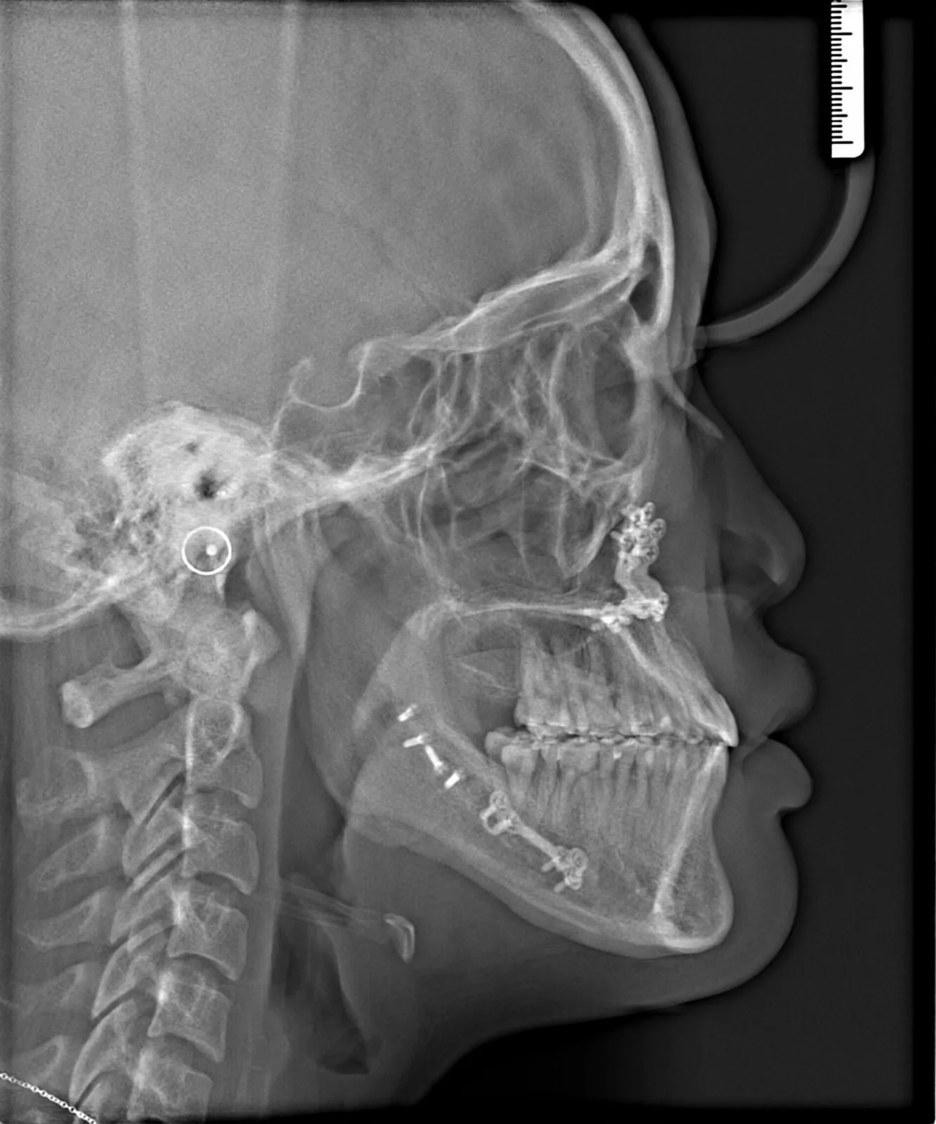 Profile after treatment