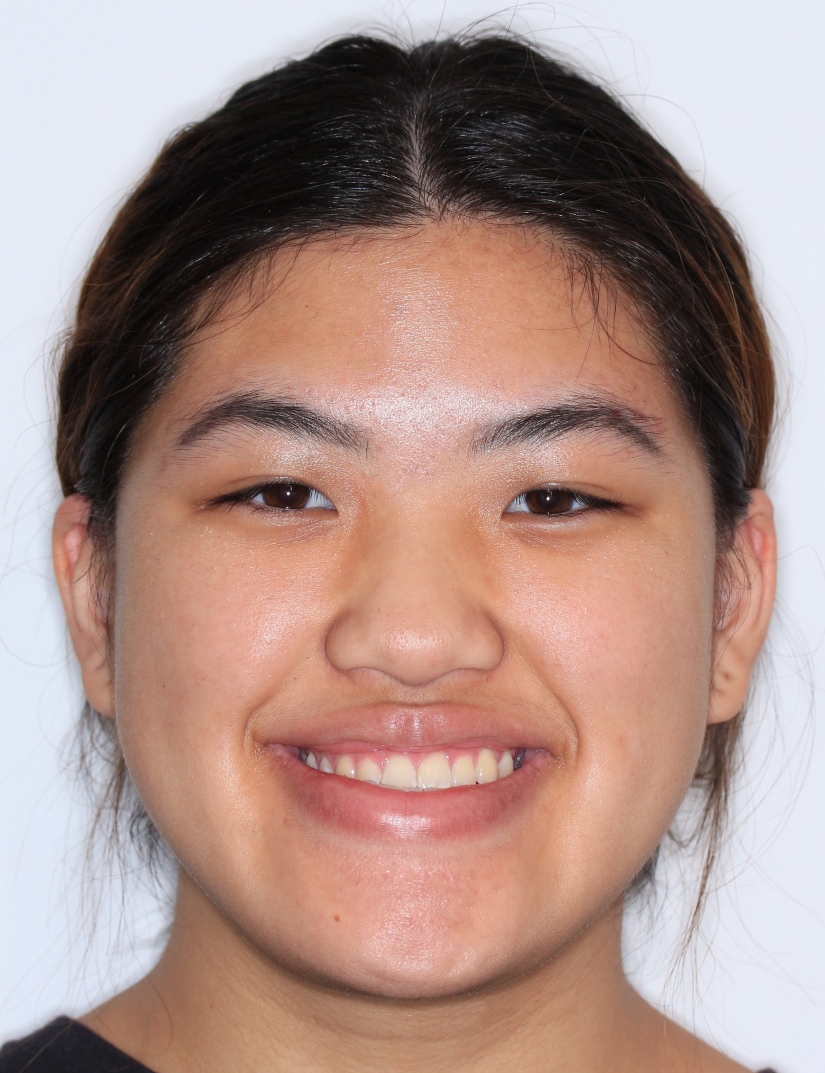 Before Metal Self-Ligating Braces & Orthognathic Surgery treatment