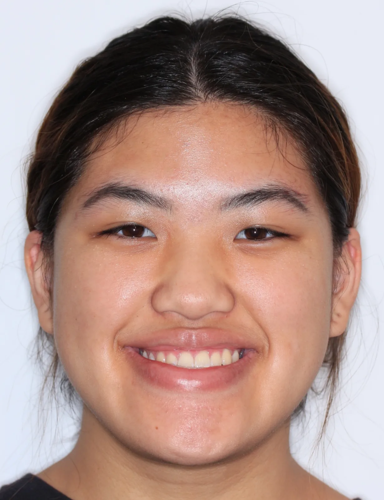 Before Metal Self-Ligating Braces & Orthognathic Surgery treatment