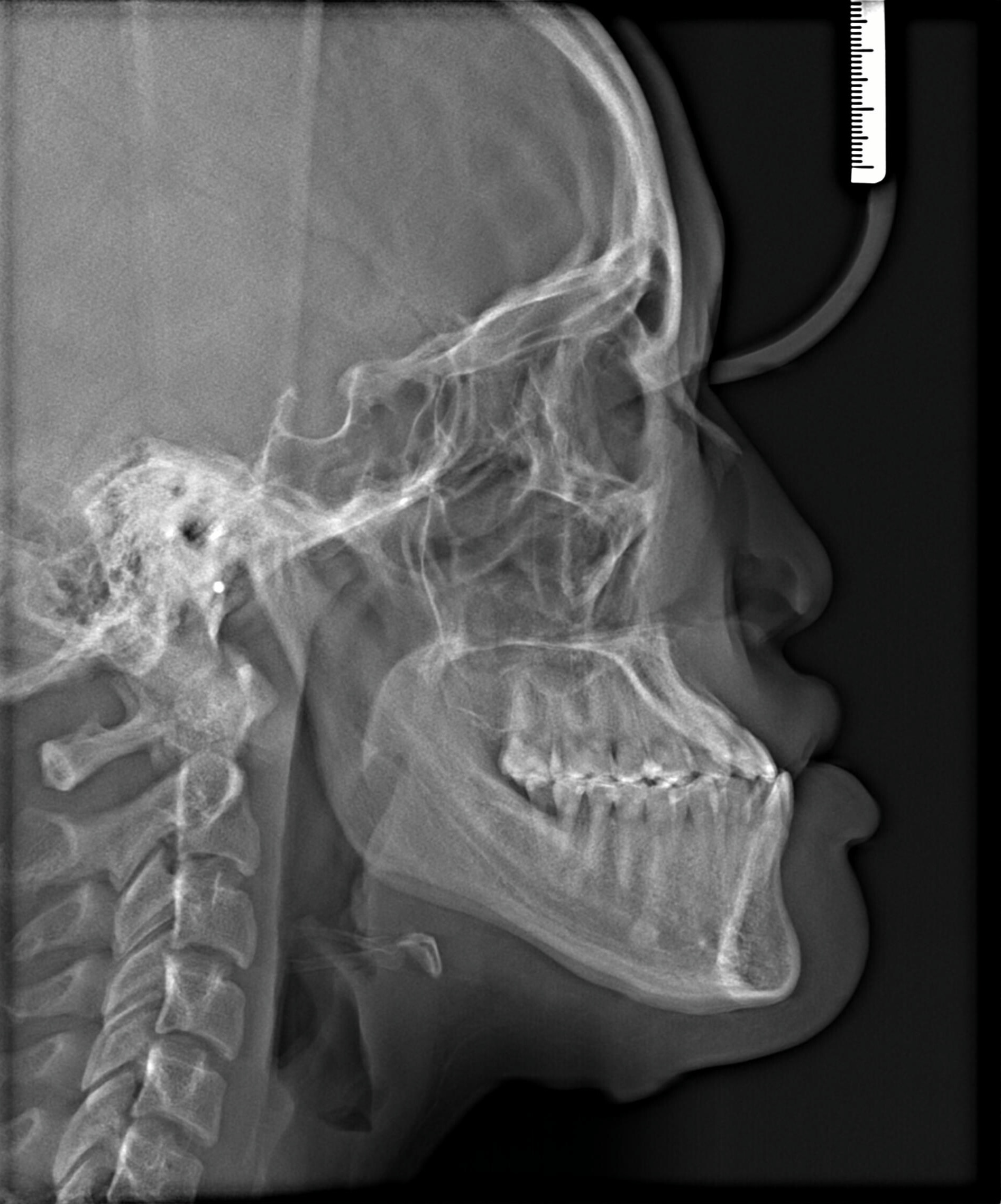 Profile before treatment