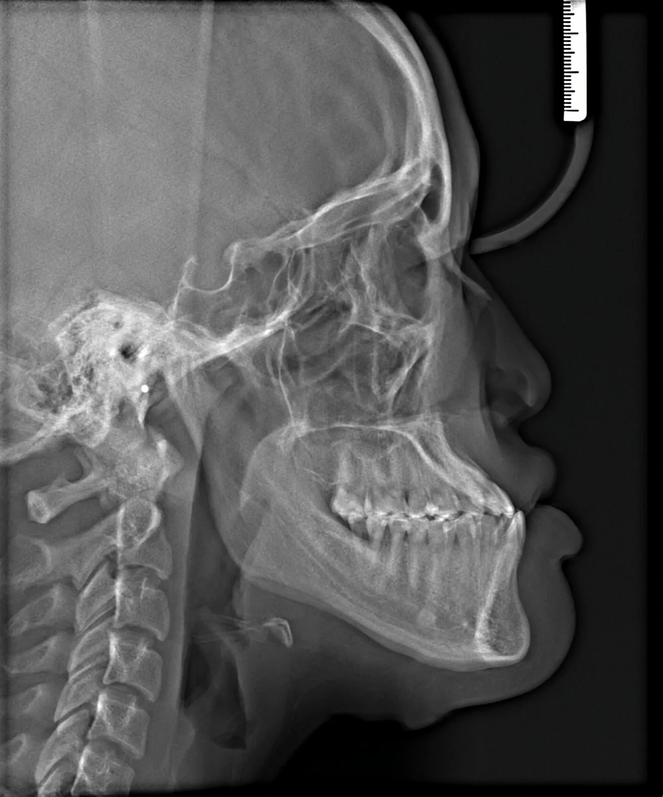 Profile before treatment