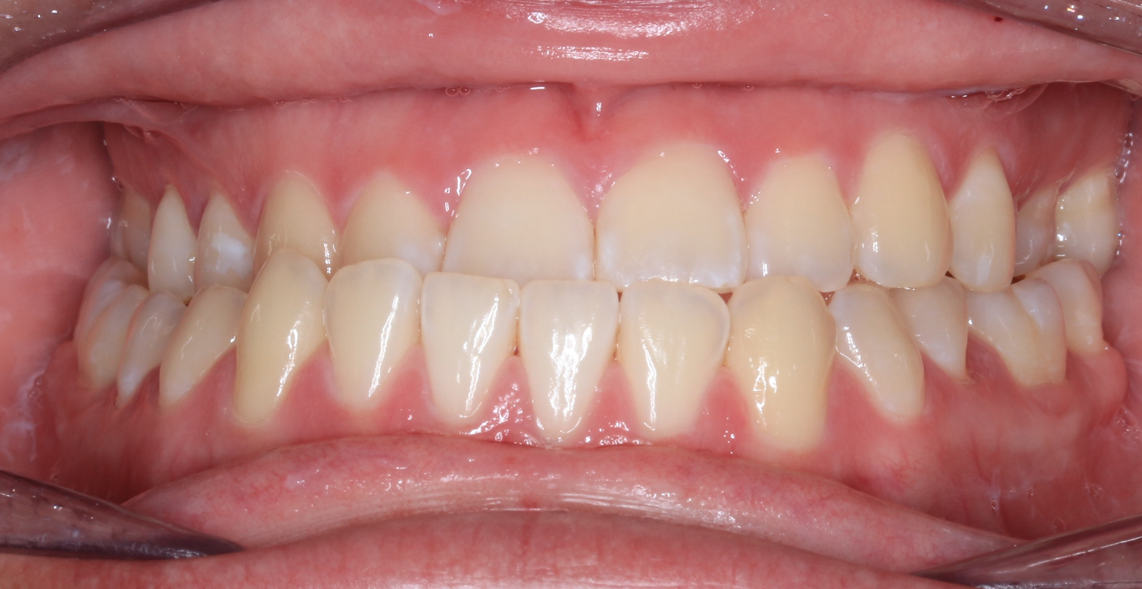 Intraoral before treatment