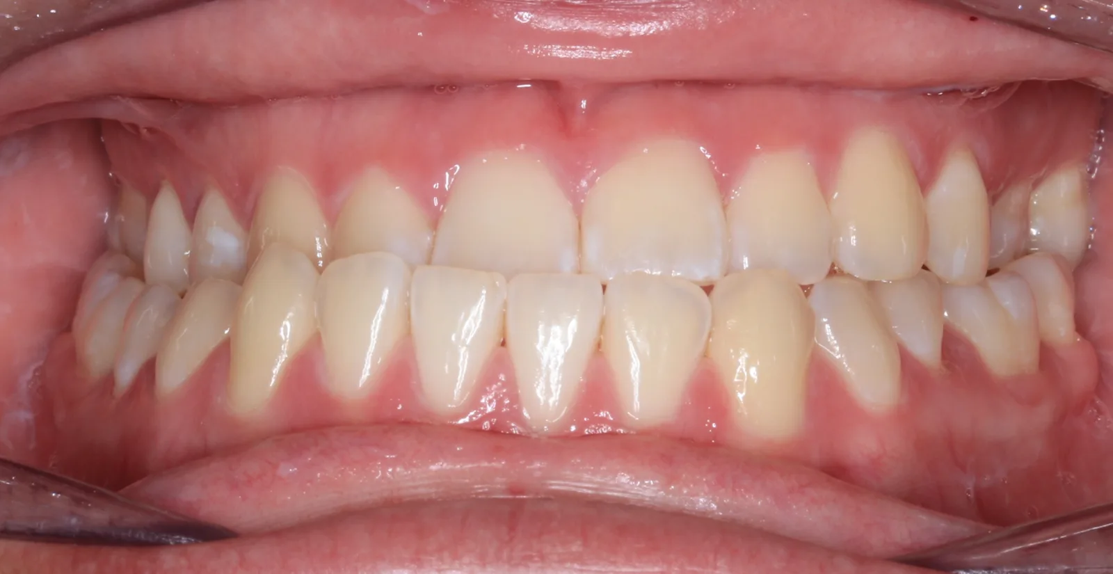 Intraoral before treatment
