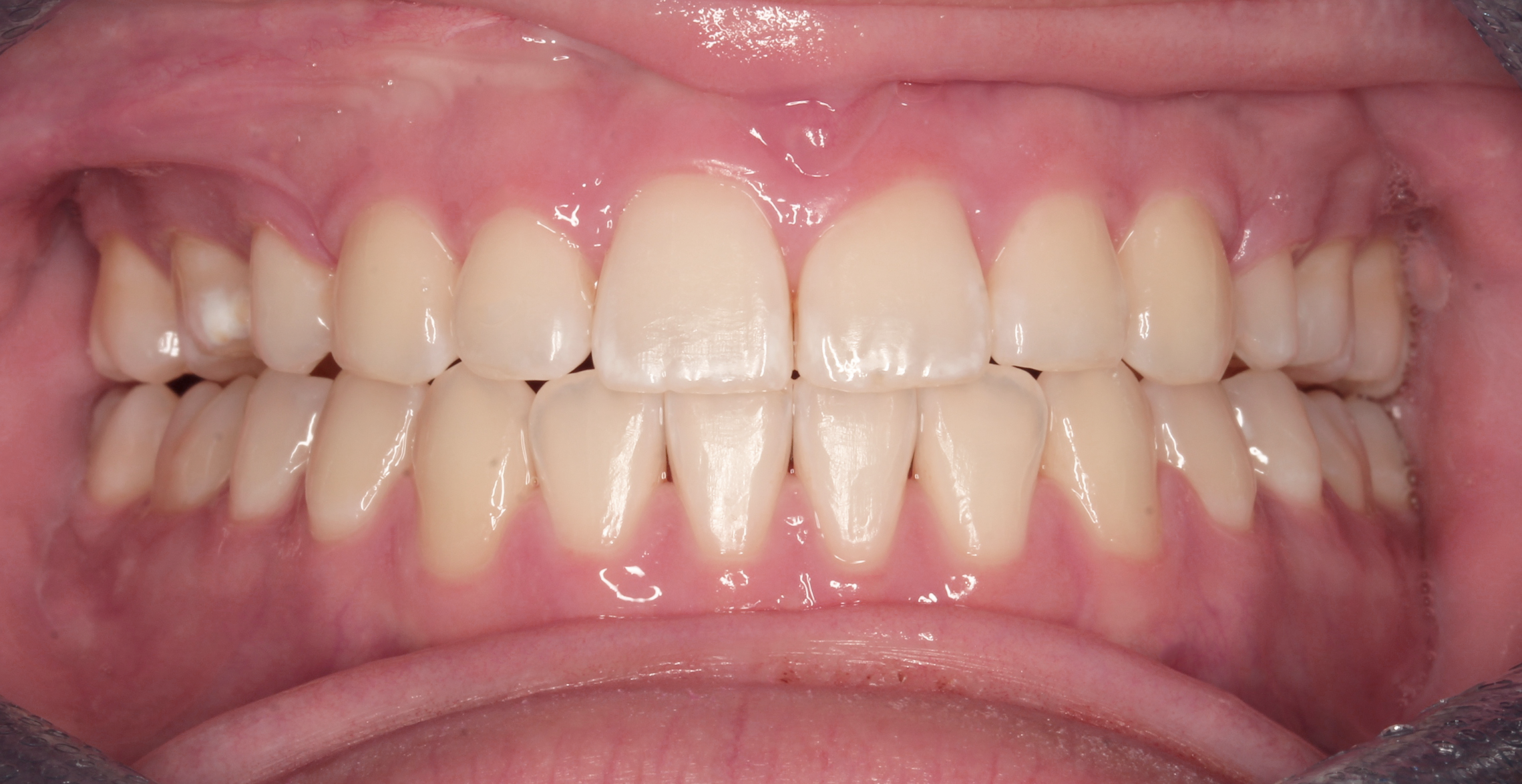 Intraoral after treatment
