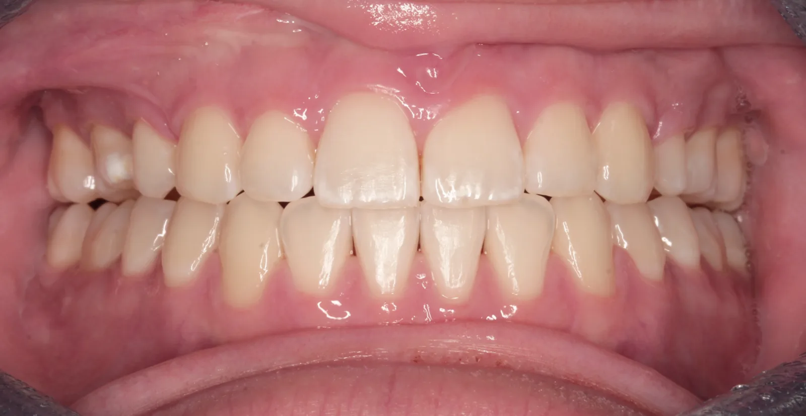 Intraoral after treatment