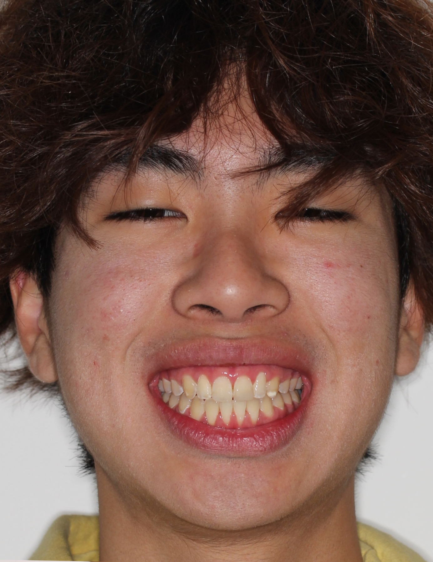 After Metal Self-Ligating Braces treatment