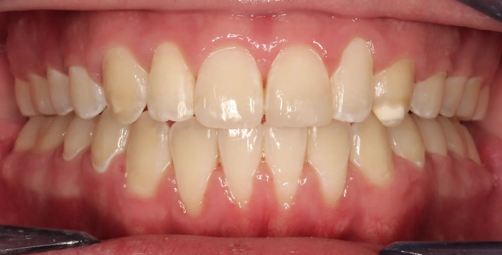 After teeth alignment comparison: Intraoral after photo of Metal Self-Ligating Braces showing using pitts 21 self-ligating braces, dr.