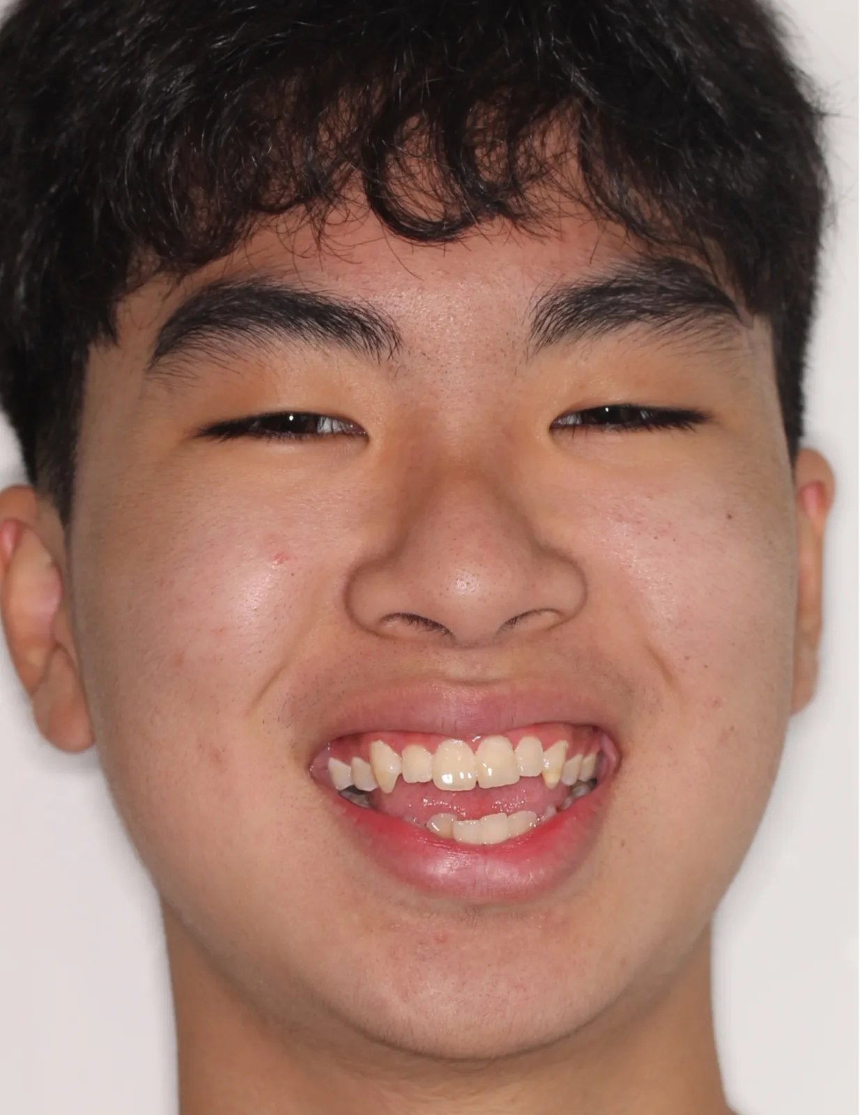 Before Metal Self-Ligating Braces treatment