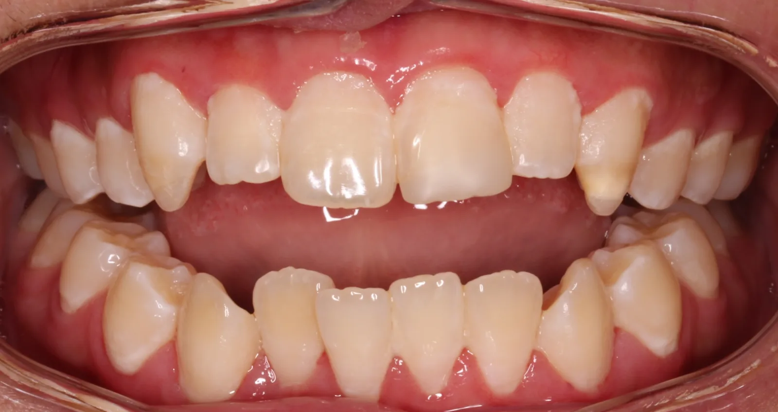 Before teeth alignment comparison: Intraoral before photo of Metal Self-Ligating Braces showing the before records reveal the asymmetry clearly — crowding in both arches and a midline that had shifted noticeably to the left.