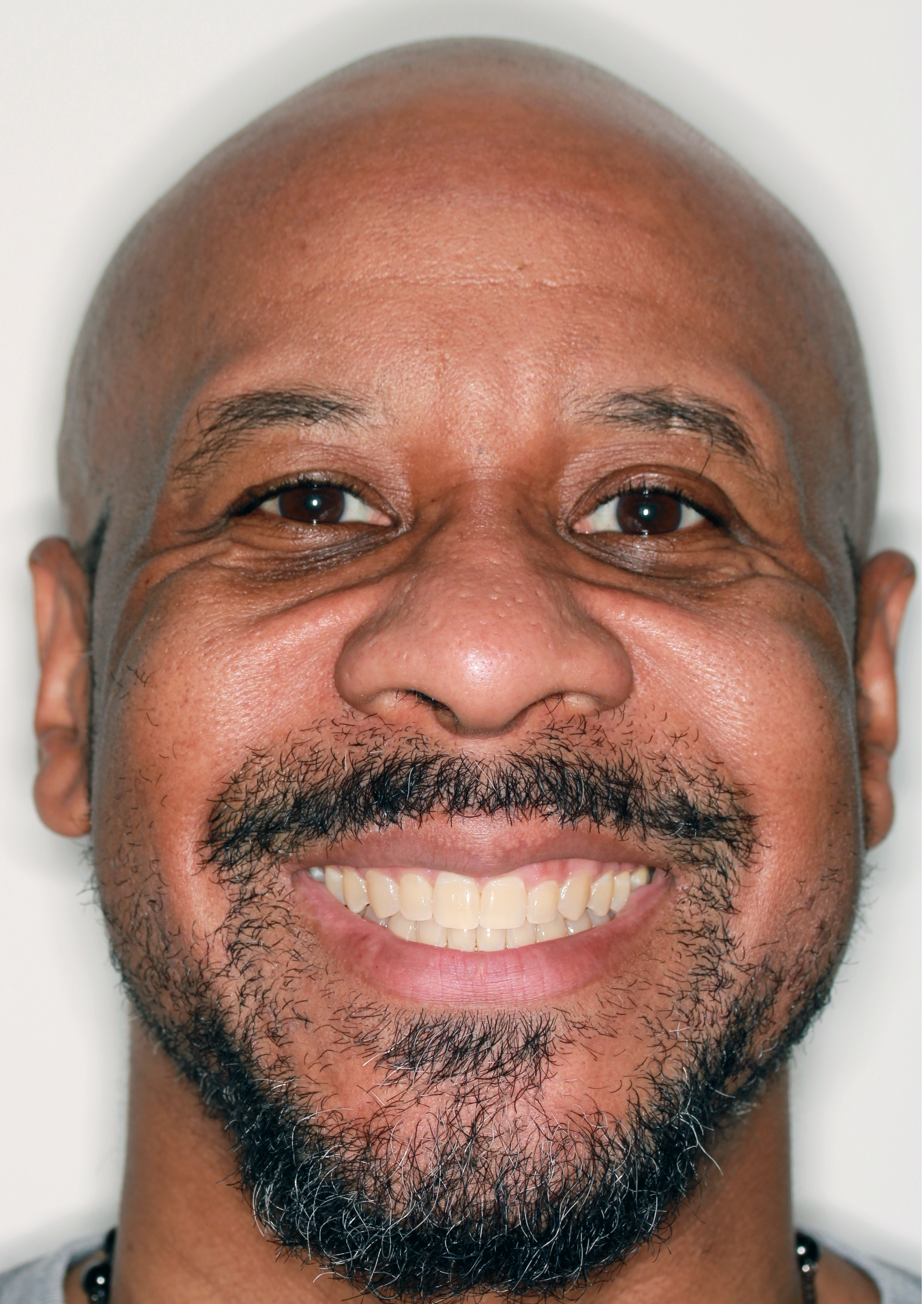 After Metal Self-Ligating Braces treatment