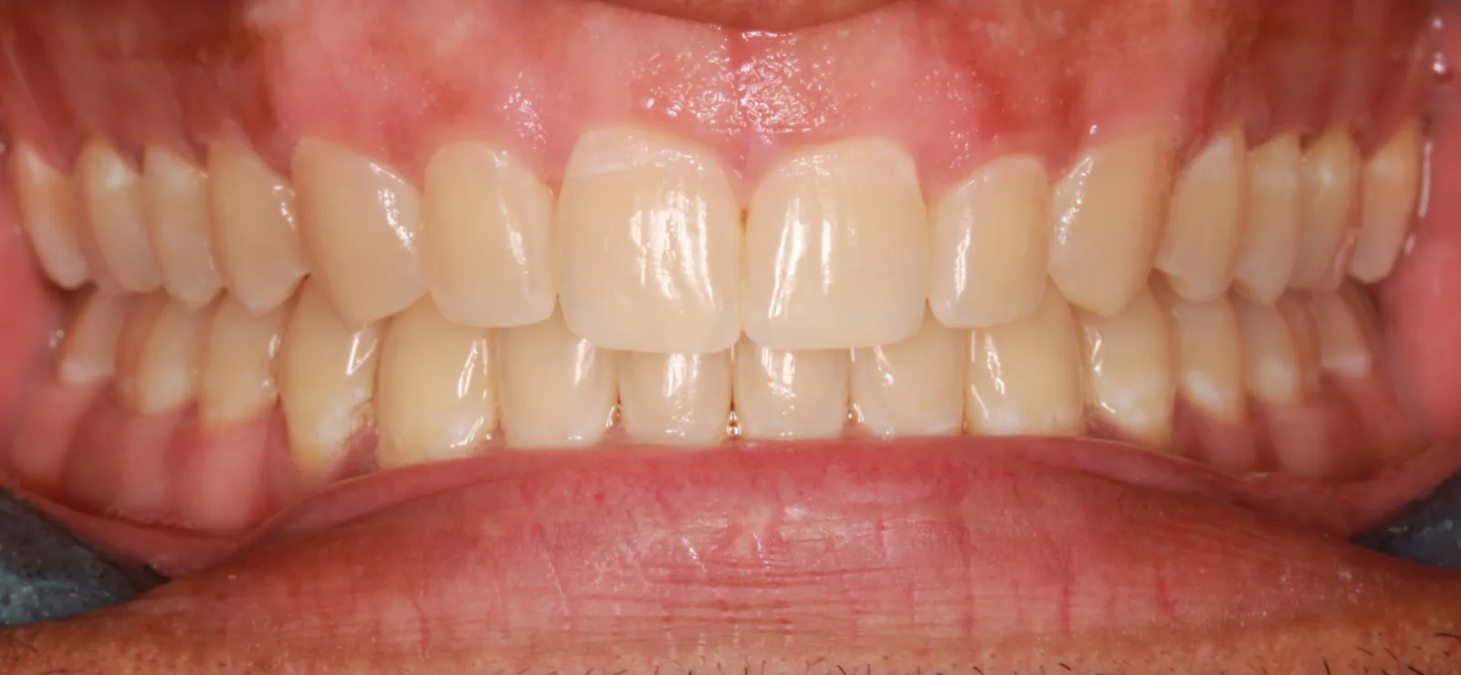 After teeth alignment comparison: Intraoral after photo of Metal Self-Ligating Braces showing dr.