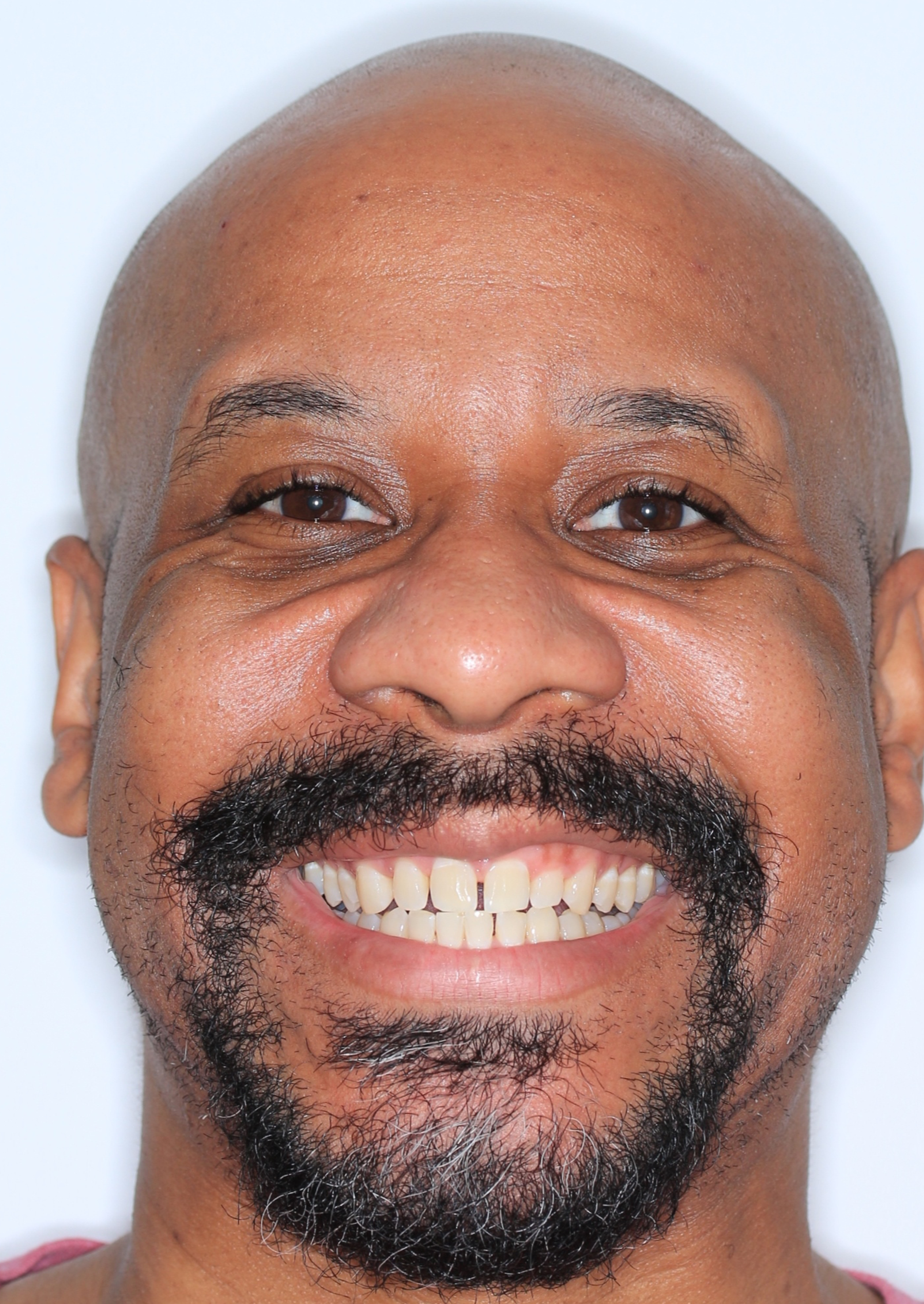 Before Metal Self-Ligating Braces treatment