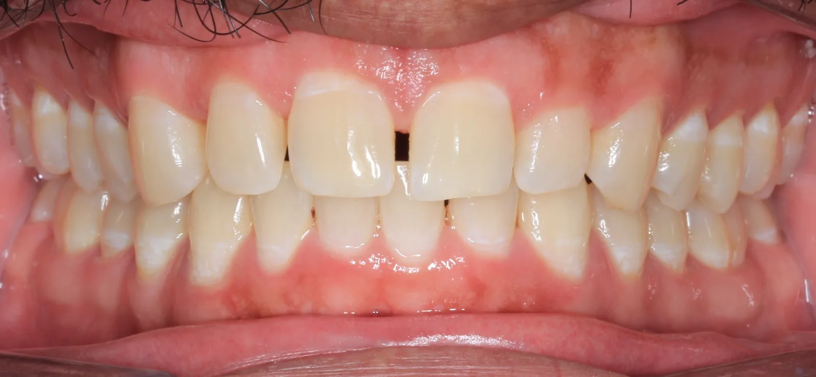 Before teeth alignment comparison: Intraoral before photo of Metal Self-Ligating Braces showing the patient presented with anterior spacing, a tooth-size discrepancy and asymmetry, off-center midlines, and a slightly reverse smile curve.