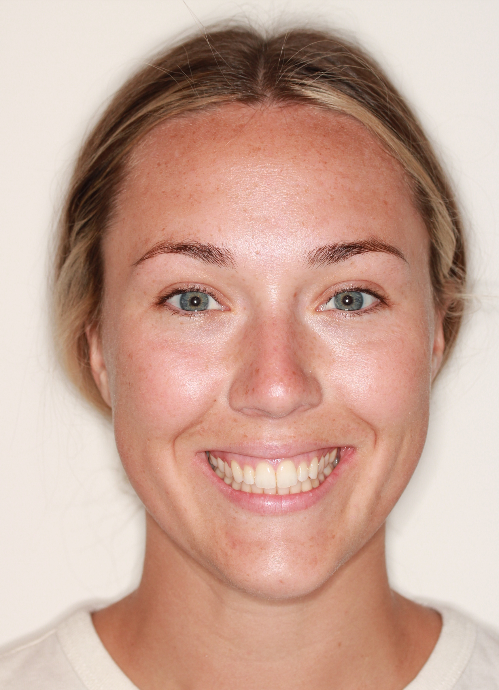 After InSmile (formerly InBrace) treatment