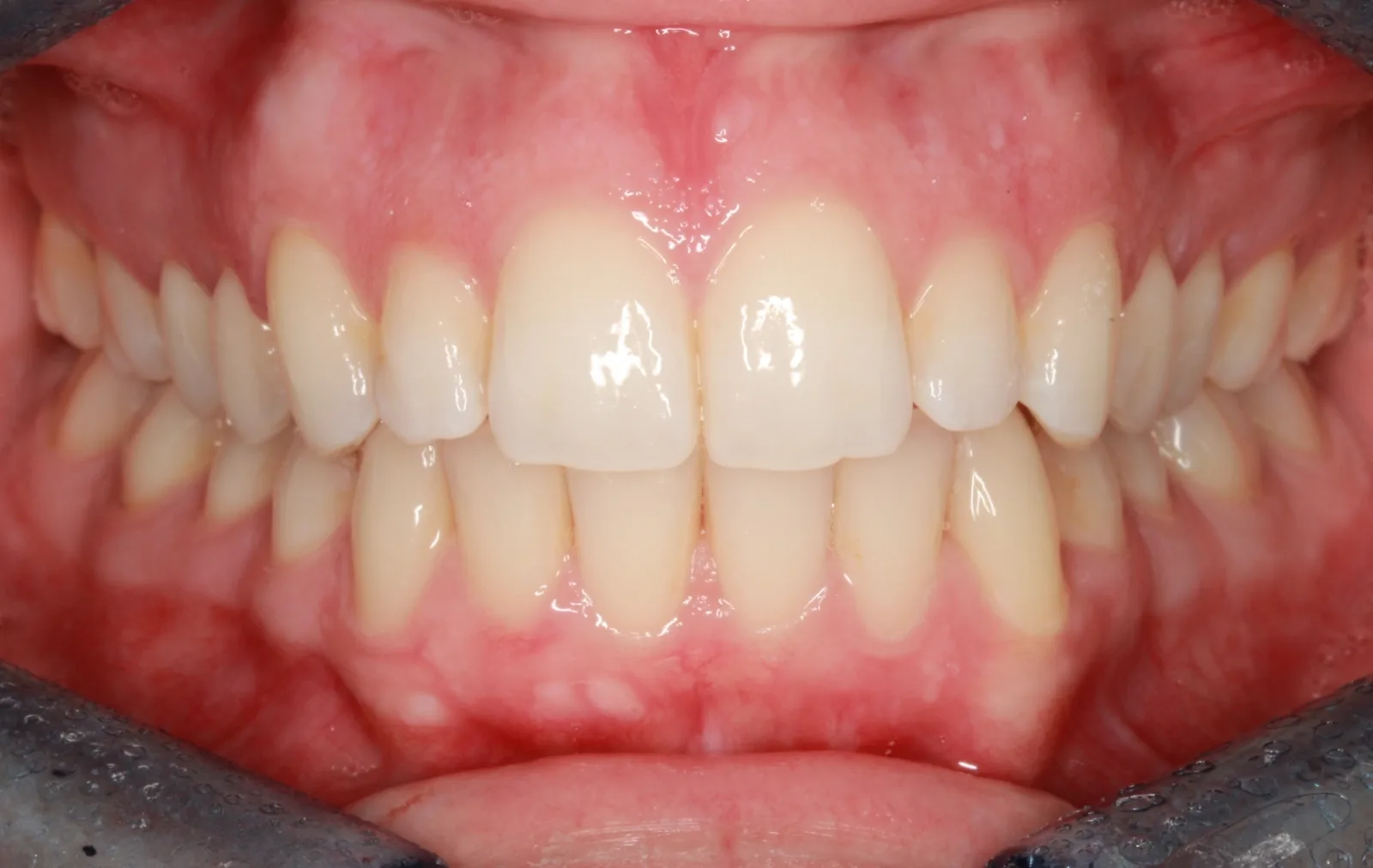 After teeth alignment comparison: Intraoral after photo of InSmile (formerly InBrace) showing the goal was a completely invisible treatment that still delivered a high-level result.