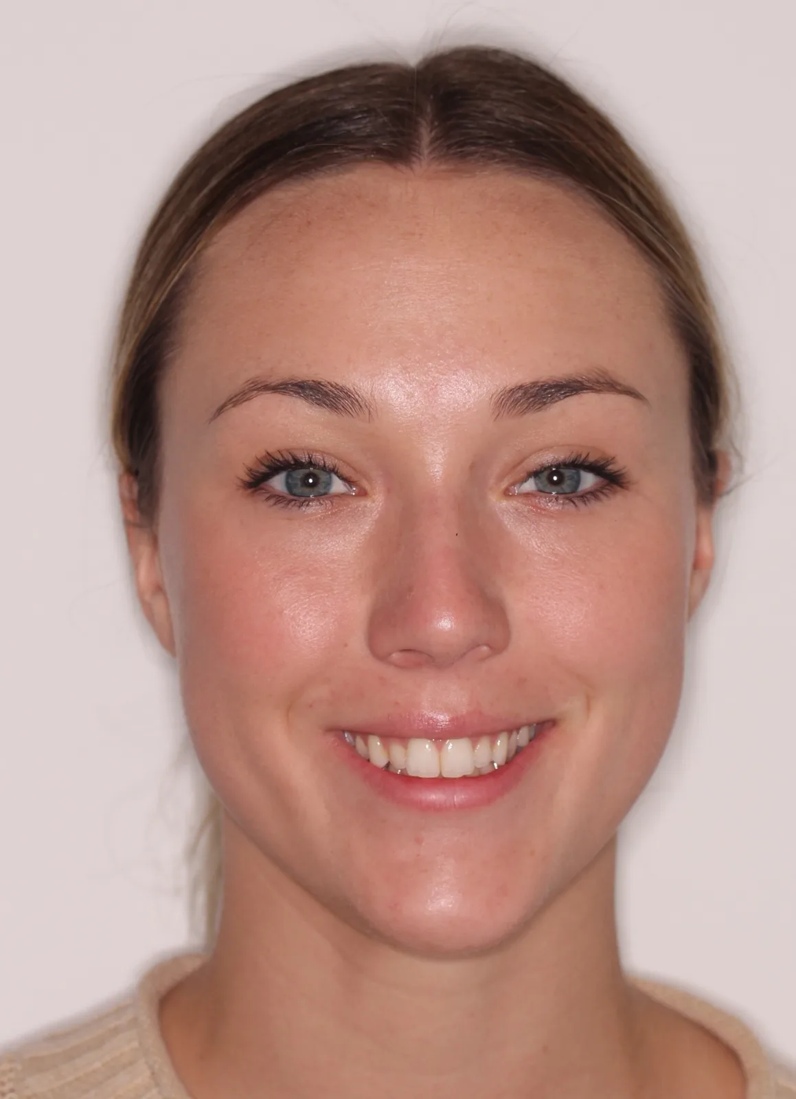 Before InSmile (formerly InBrace) treatment