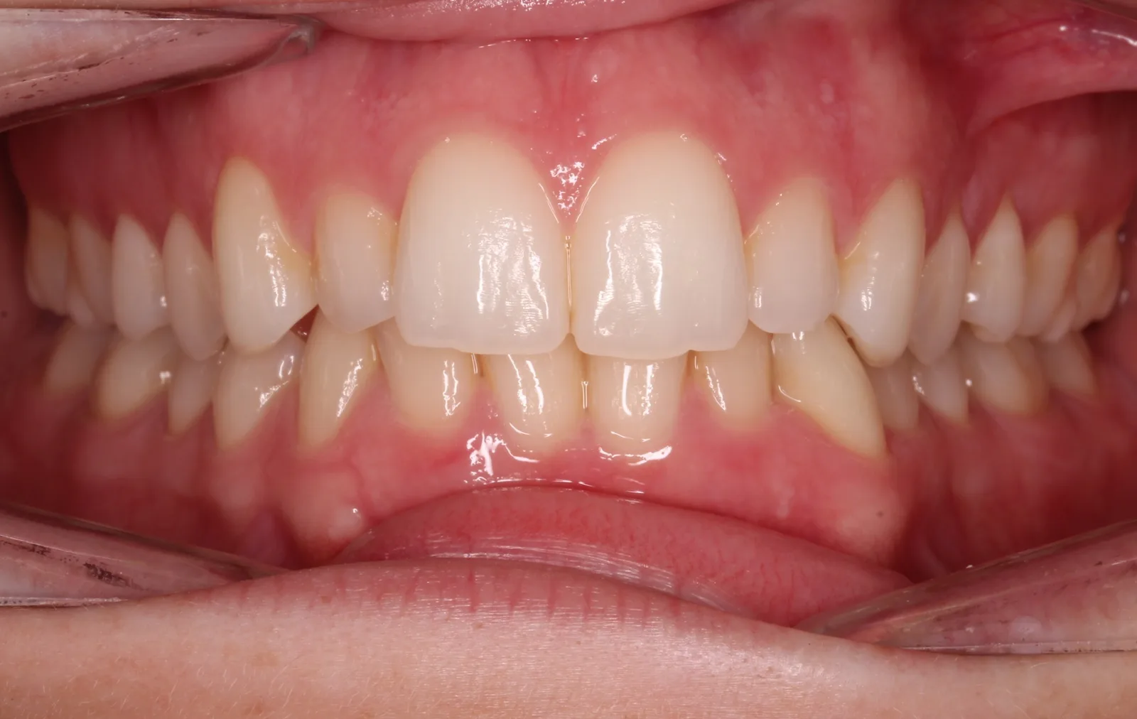 Before teeth alignment comparison: Intraoral before photo of InSmile (formerly InBrace) showing showing moderate lower crowding with rotations and upper spacing — a common pattern that affects smile symmetry.