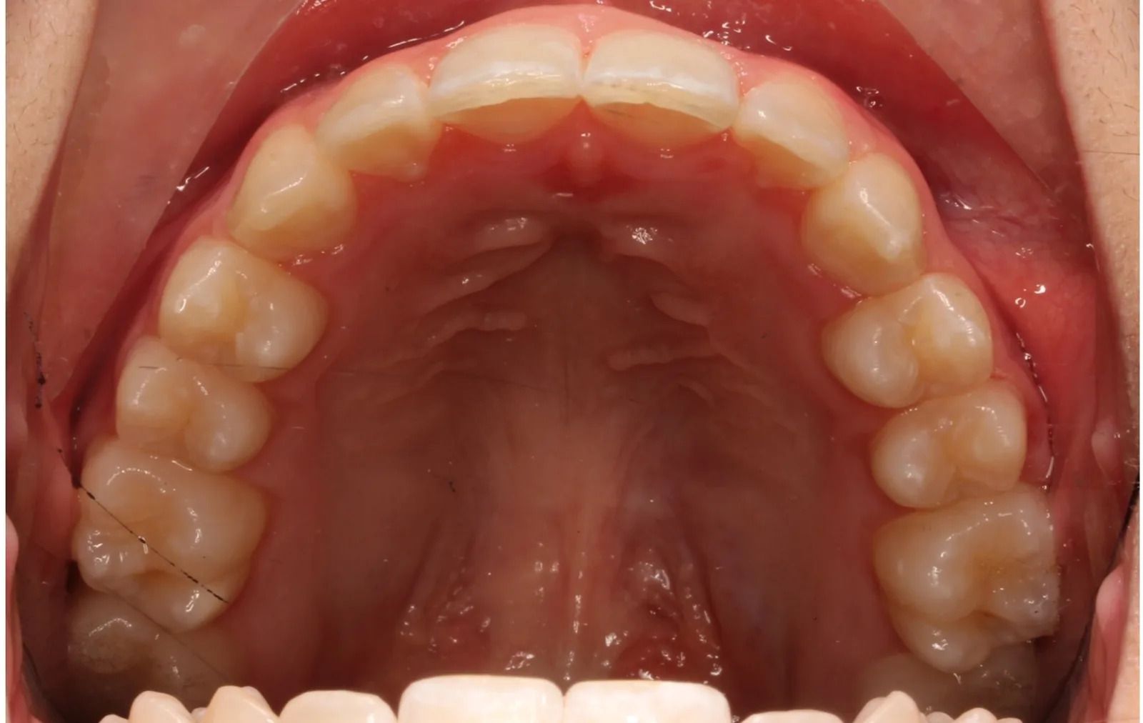 palatal expander in adults before and after - Upper occlusal view showing broad upper arch and fully resolved crowding after non-surgical MARPE treatment