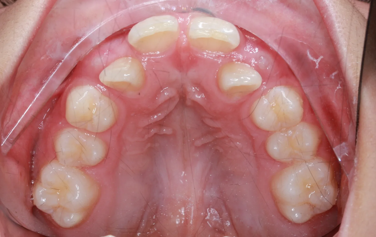 palatal expansion adults before and after - Upper occlusal view showing narrow upper jaw and severe crowding before MARPE treatment at The Art of Braces in Las Vegas