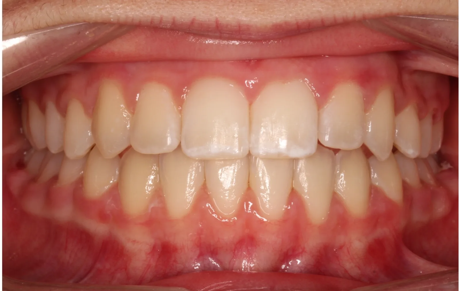 After teeth alignment comparison: Intraoral after photo of Metal Self-Ligating Braces showing she started with a narrow smile that didn't fully fill her lip frame.