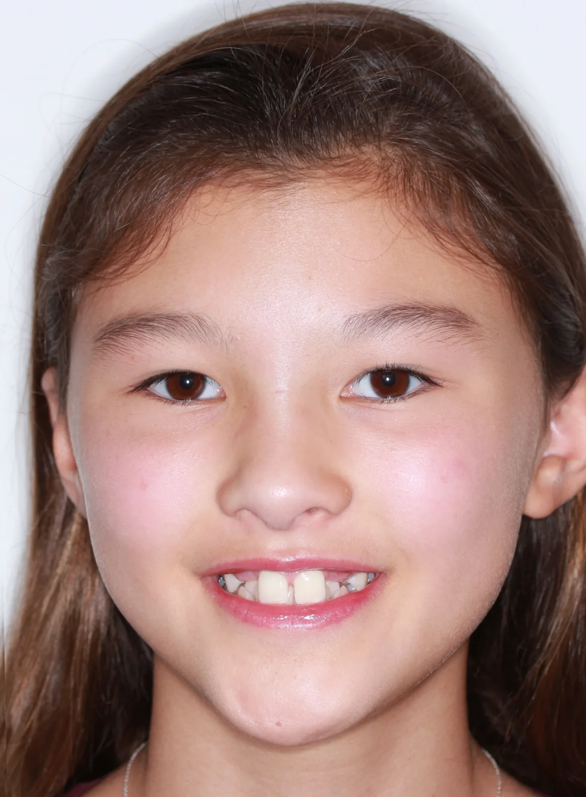 Before Metal Self-Ligating Braces treatment