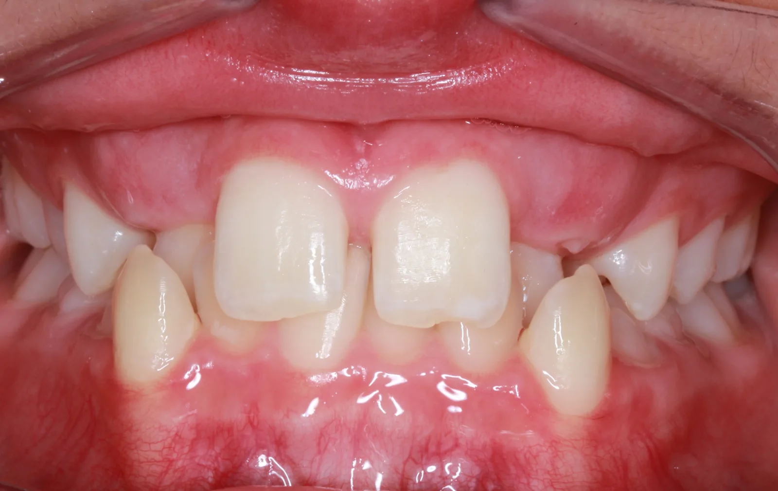 Before teeth alignment comparison: Intraoral before photo of Metal Self-Ligating Braces showing showing two arches transformed.