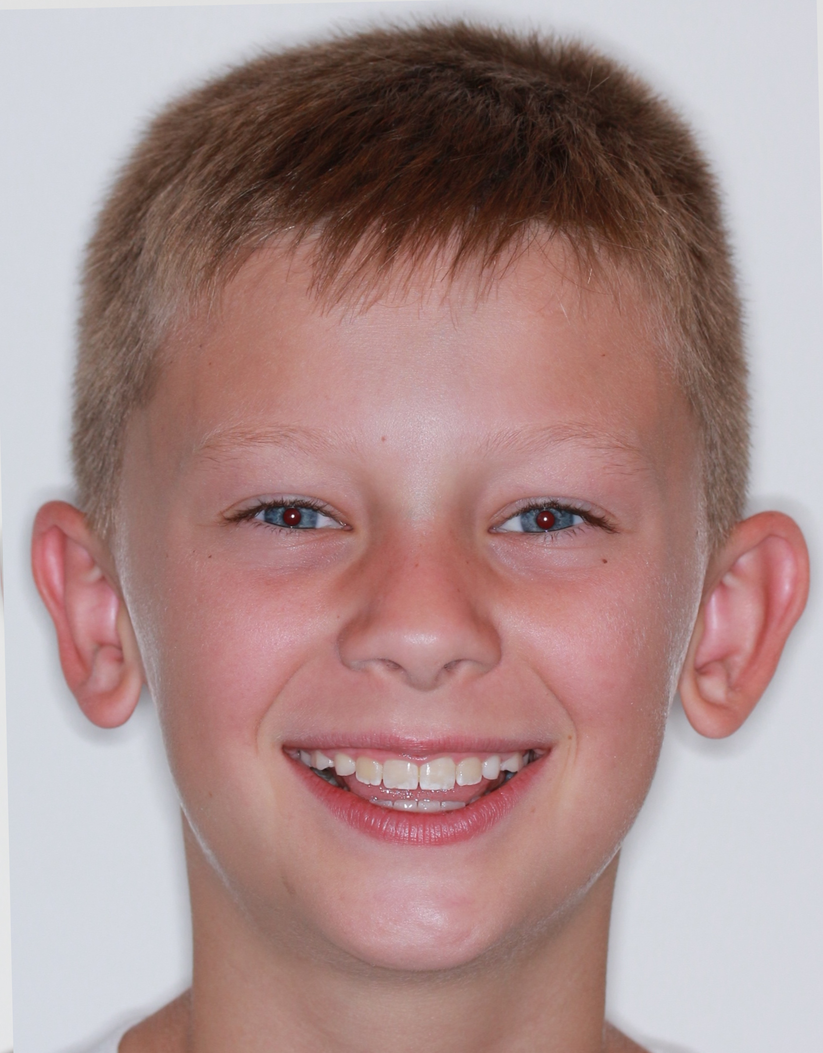 After Phase I Braces treatment