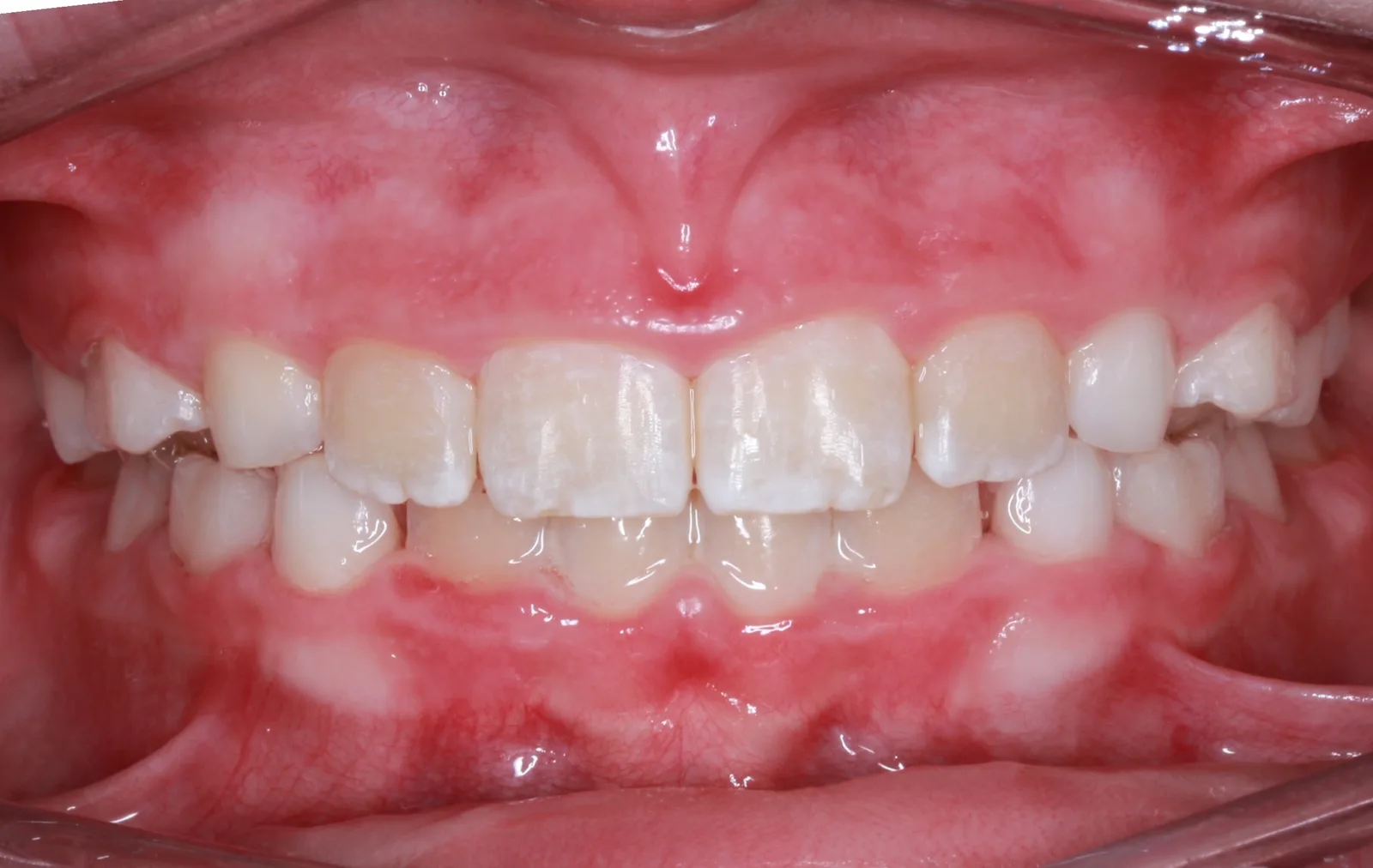 After teeth alignment comparison: Intraoral after photo of Phase I Braces showing using phase i upper and lower braces, dr.