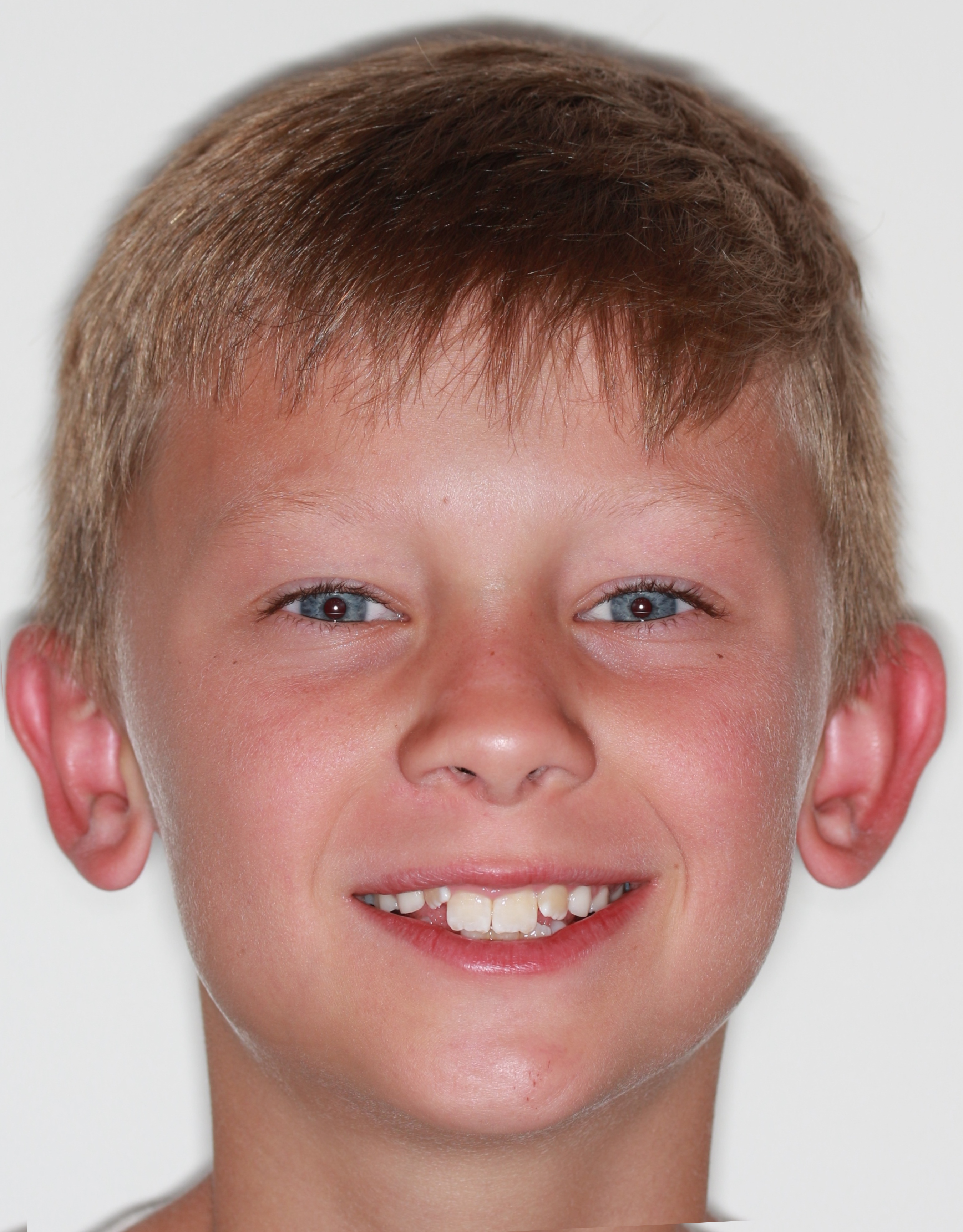 Before Phase I Braces treatment