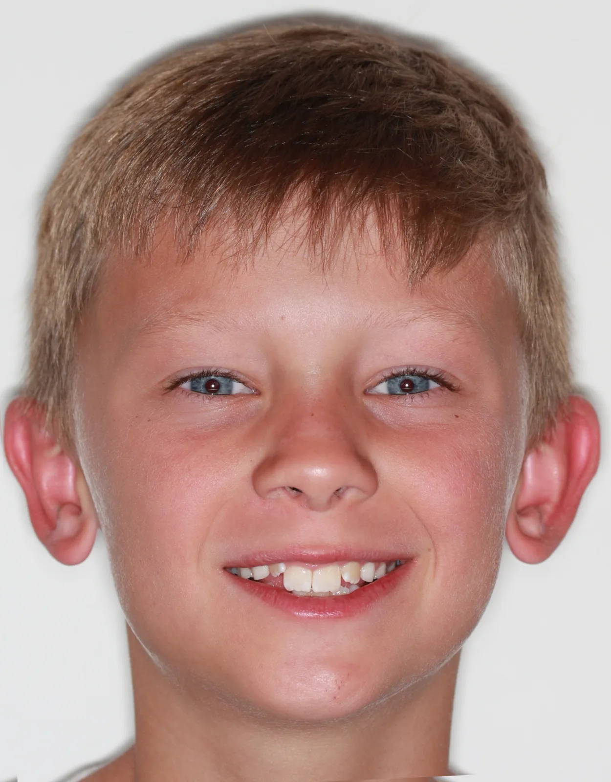 Before Phase I Braces treatment