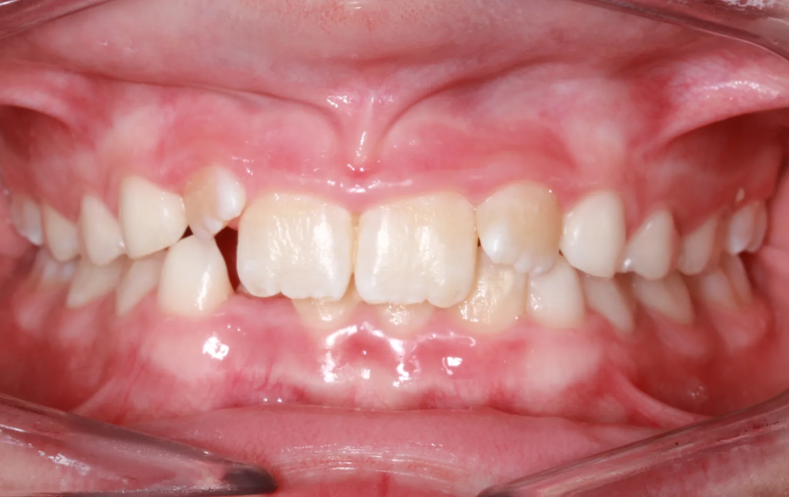 Before teeth alignment comparison: Intraoral before photo of Phase I Braces showing these records capture the power of early intervention.