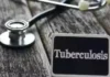 bbff tuberculosis