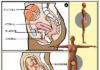 e vesicovaginal fistula