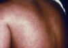 ffba a woman with marburg virus infection has a rash on her back