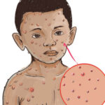 ab measles in children x