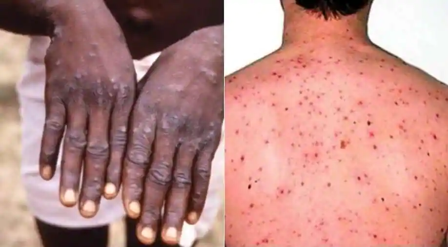 Nigeria daily how to prevent mpox from spreading - nigeria newspapers online