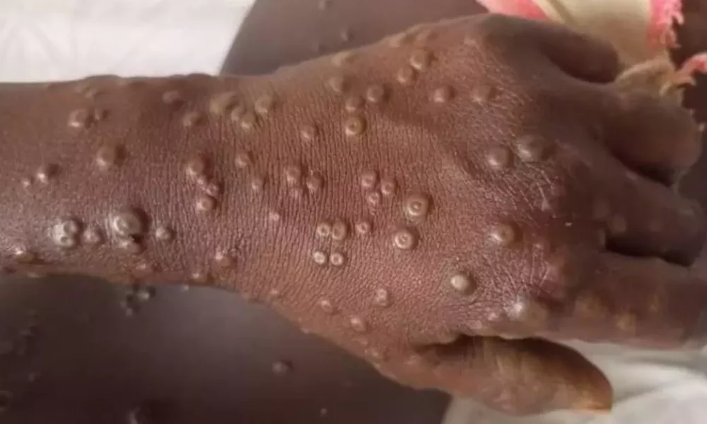 Benue records 20 suspected cases of mpox four confirmed - nigeria newspapers online