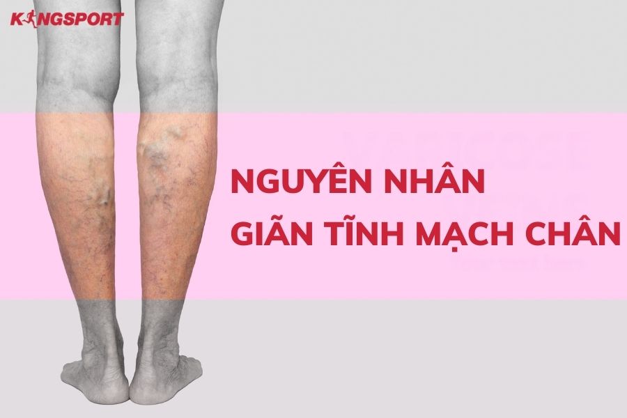 nguyên nhân giãn tĩnh mạch chân 1