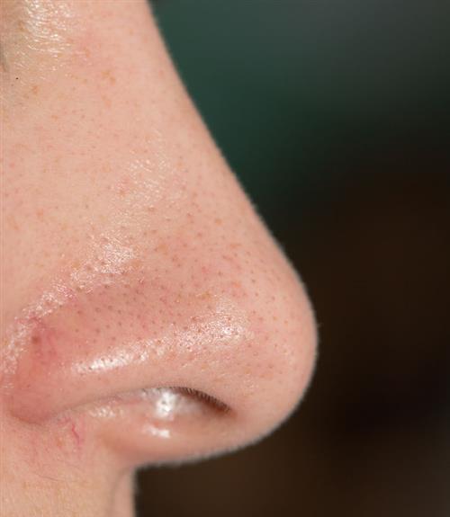 Blackheads, whiteheads