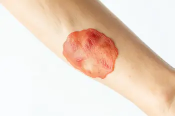 Warning signs of eczema: Clinical indicators and professional observation guidelines