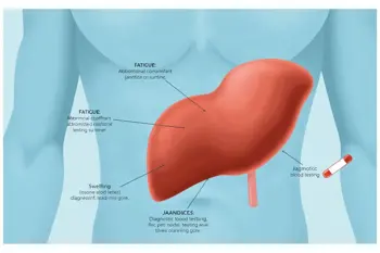 Warning signs of fatty liver disease: A clinical guide to symptoms and progression