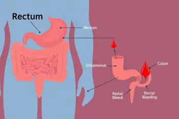 Warning signs of ulcerative colitis: Clinical indicators and when symptoms warrant evaluation