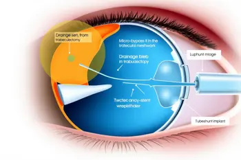 Understanding the different types of glaucoma surgery: A Clinical Guide to Procedures, Risks, and Patient Selection