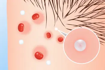 Signs you may have folliculitis: A Clinical Guide to Recognizing Inflamed Hair Follicles