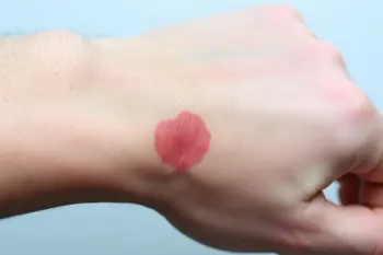 Signs you may have contact dermatitis: A Clinical Overview of Skin Reactivity