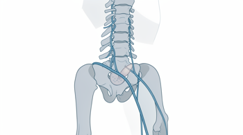 Assessing your options for chronic sciatica: A Clinical Guide to Diagnosis, Treatment Pathways, and Long-Term Relief