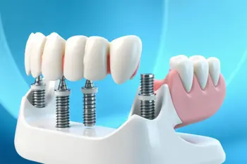 Analyse clinique 2026 : Aperçu des prothèses amovibles sur implants de 6 mois à Lyon avec protocoles de suivi en 2026